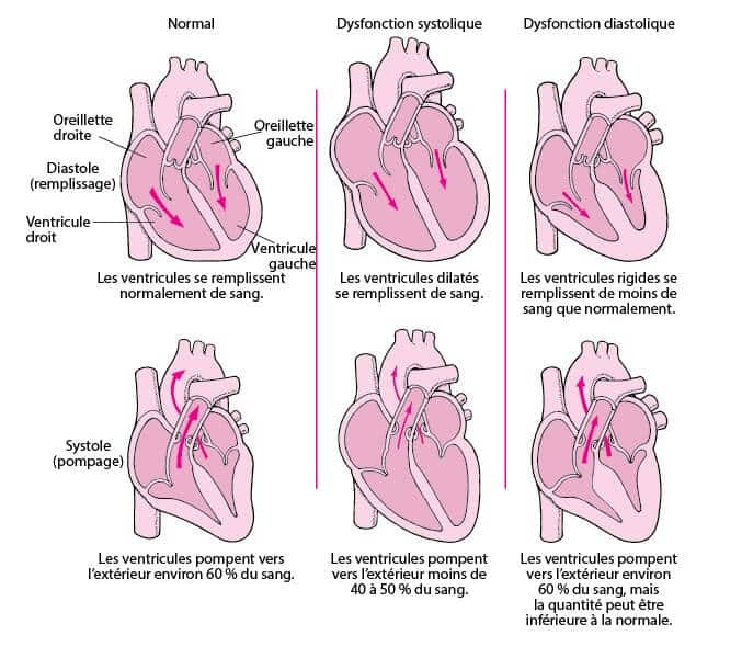 Qu'est-ce que l'insuffisance cardiaque et quels sont ses symptômes ?