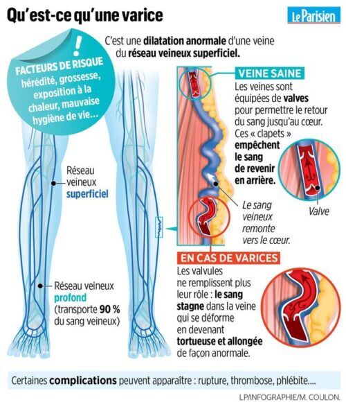 Varices Tout Savoir Sur Leurs Causes Et Les Traitements Possibles